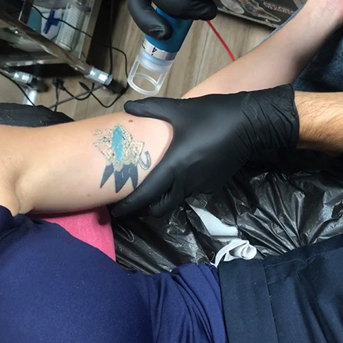 Especialistas en borrar tatuajes